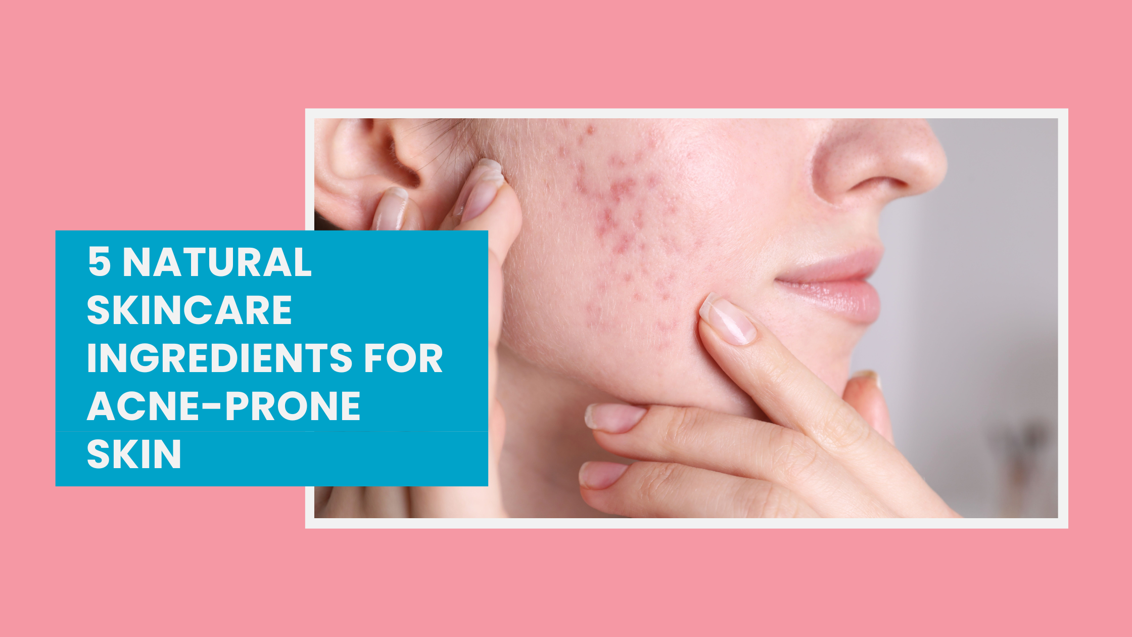 woman with her hands on her face, turned to the side, showing off acne on her cheek