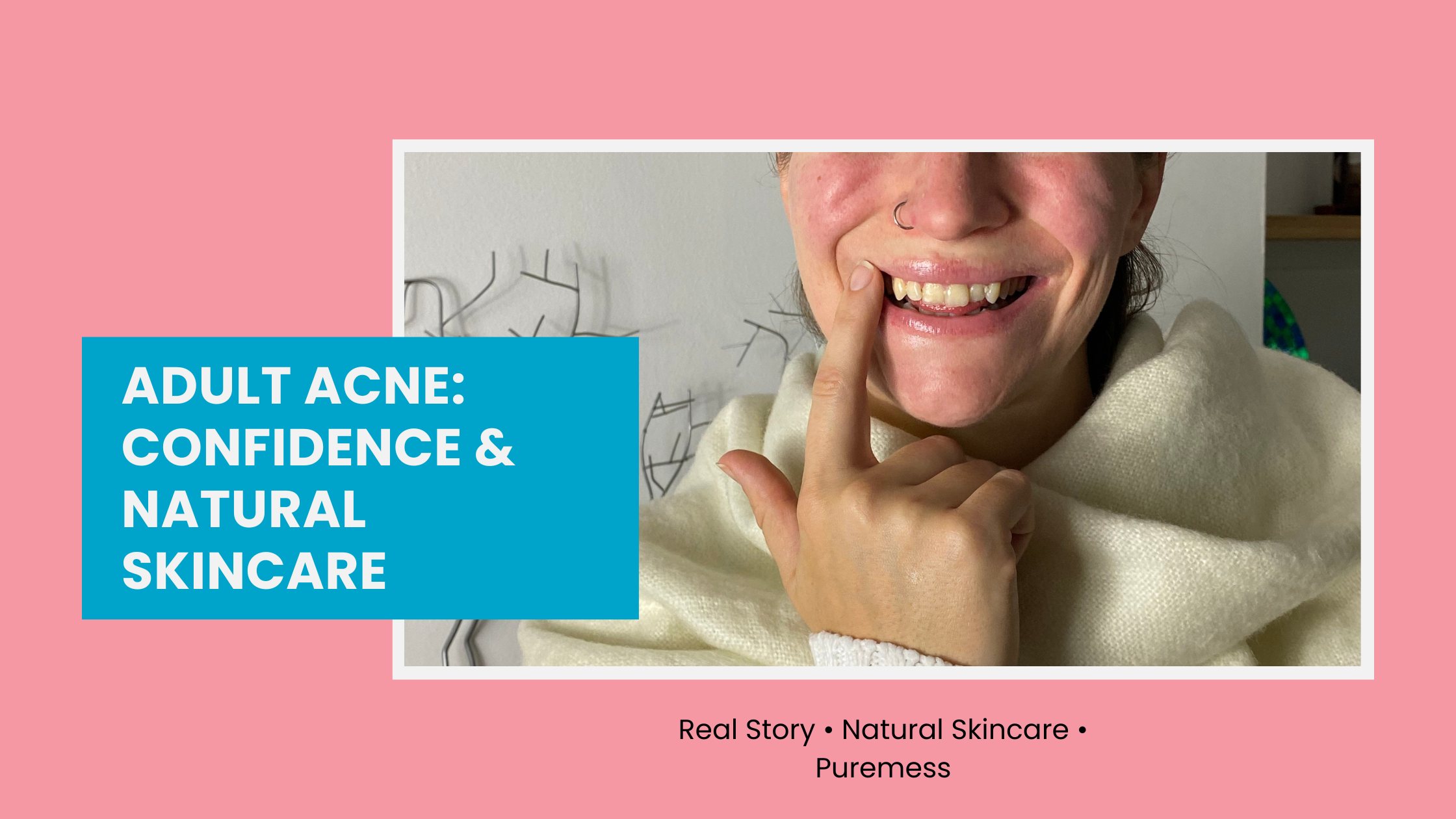 A close-up of a woman with clear skin smiling confidently, representing recovery from adult acne with natural skincare.