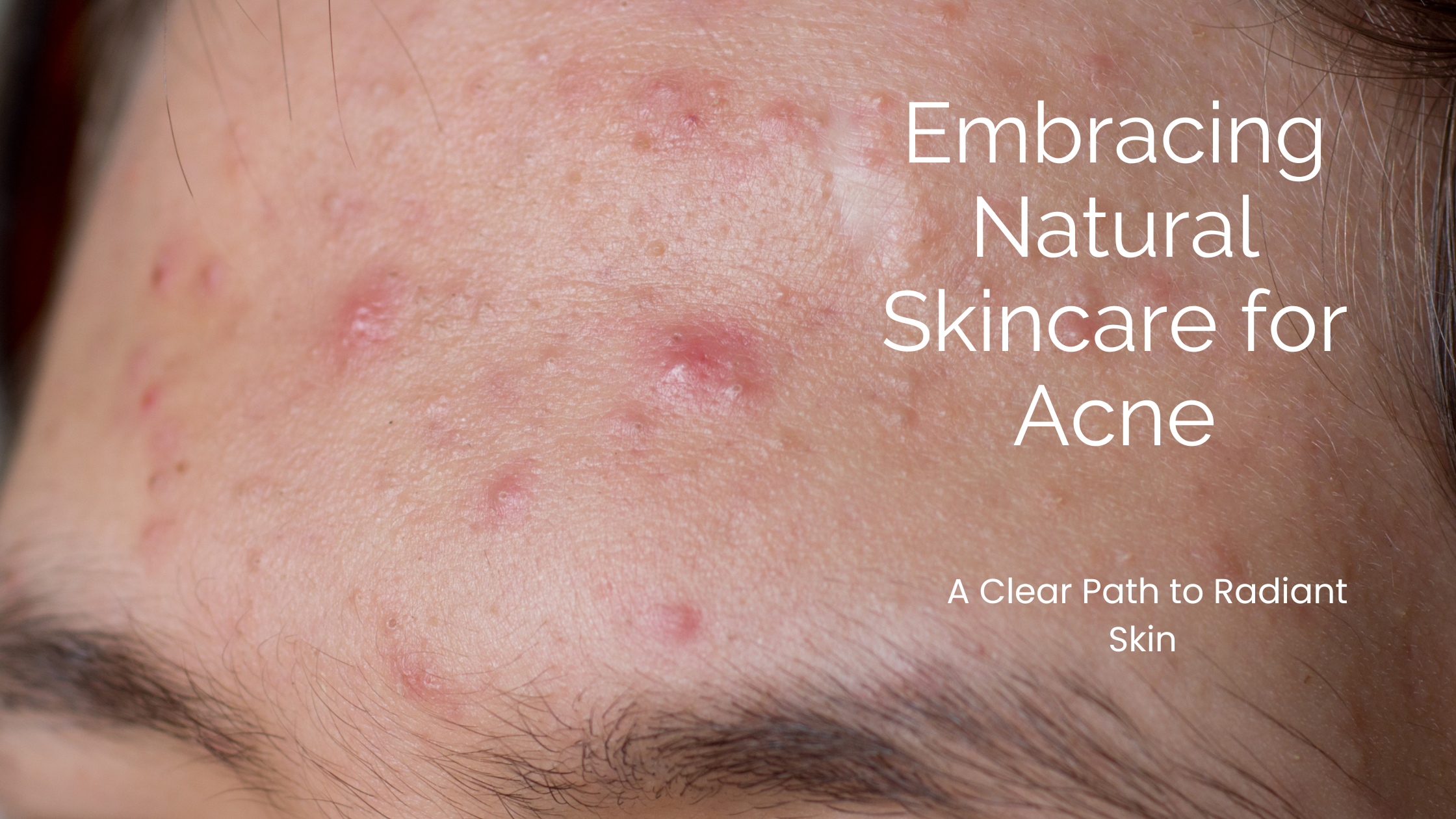 Natural Skincare for Acne: How to Support Clearer Skin Without Harsh Chemicals
